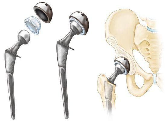 hip replacement surgery in Pune
